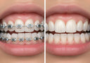 Does Byte Work for Teeth Relapse After Braces?