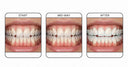 Before and after teeth alignment using NewSmile clear aligners