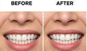 Aligners for Gap Teeth: Success Stories
