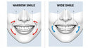 Narrow smile vs wide smile comparison highlighting buccal corridors