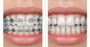 What Are Clear Aligners? Beginner’s Complete Guide