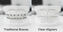 Why Clear Aligners Are Changing Modern Teeth Straightening
