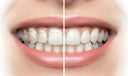 Split-screen comparison of clear aligners and veneers showing natural vs cosmetic results