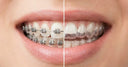 Side-by-side comparison of traditional braces and a clear retainer, showing different stages of orthodontic treatment.