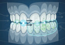 Illustration showing how a night guard reduces grinding pressure.