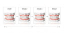 Teeth Straightening at Home with Clear Aligners from NewSmile