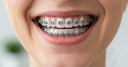 Metal braces actively correcting teeth misalignment for a healthy bite