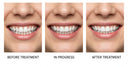 A Revolutionary Approach to Teeth Straightening: Your New Smile Awaits