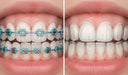 Aligners vs. Braces: Weighing the Pros and Cons for Your Perfect Smile