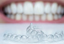 Clear aligners on teeth without attachments for discreet treatment