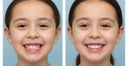 The Ultimate Guide to Invisible Braces for Kids: Straightening Smiles with Ease