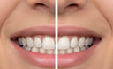 Before and after clear aligner treatment for crowded teeth