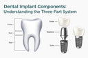 Unveiling the Mystery: "What is Dental Implant?"