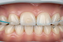 Can Aligners Fix Rotated Teeth?