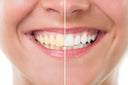 Teeth Whitening Tips You Can Try At Home