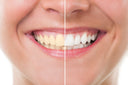 Teeth Whitening Tips You Can Try At Home