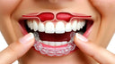 Clear aligner being placed with sinus cavity highlighted above the upper arch.