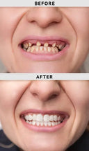 Before and after smile transformation with immediate dentures