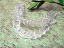 Can Clear Aligners Fix Overbite?