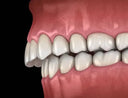😁 Crossbite Solutions: Do Retainers Work?