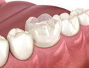 🦷 Cracked Teeth Prevention With Retainers