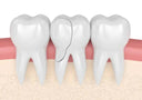 Cracked-Teeth-How-Retainers-Protect-You NewSmile™ USA
