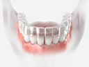Gap-Teeth-Can-Retainers-Close-Them NewSmile™ USA