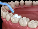 Dental inlay being placed inside a prepared tooth cavity
