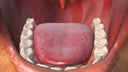 Retainers & Tongue Sores: How to Stop Them