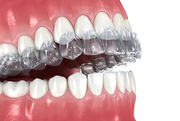 Can Retainers Help with Overbite Correction? – NewSmile™ USA