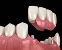 3D illustration of dental bridge supported by crowns