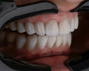 Beneath the Surface: The Surprising Health Benefits of Clear Aligners