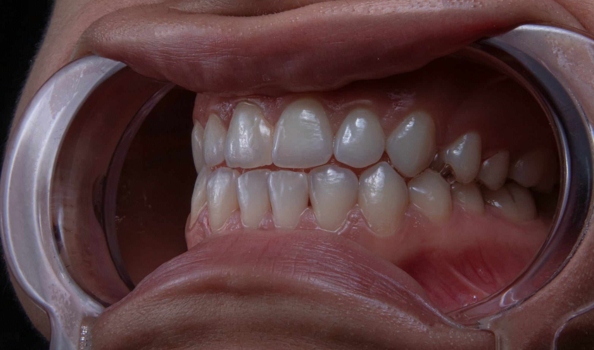 Straight Secrets: What Dentists Won’t Tell You About Clear Aligners (But Should)
