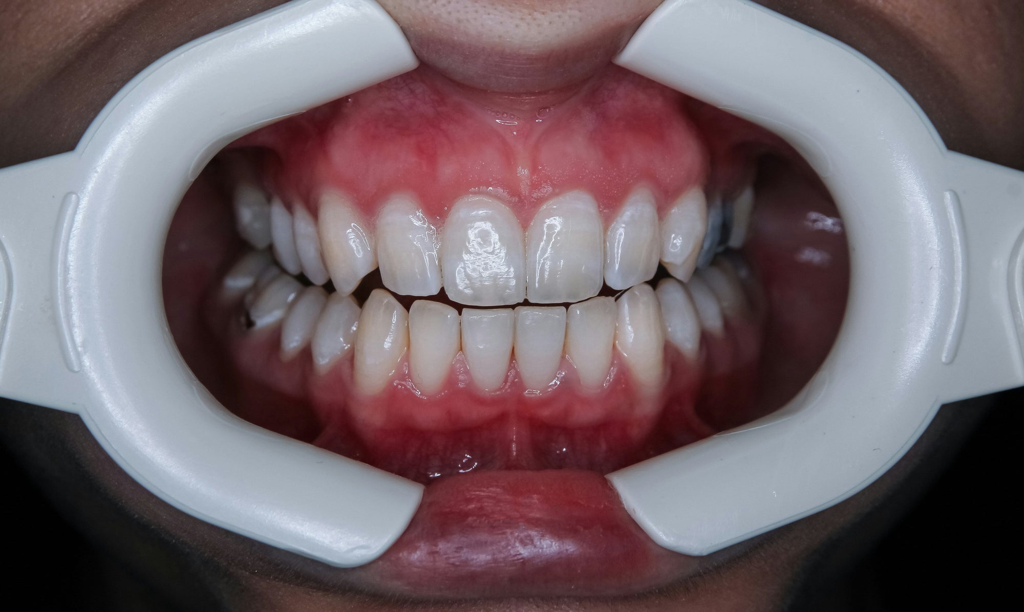 The Invisible Revolution: How Clear Aligners Are Quietly Reshaping Modern Identity