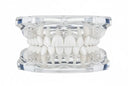 Aligners for Open Bite: Can They Help?