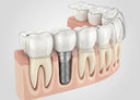 Retainers used safely with dental implants