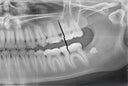 Cracked Teeth: How Night Guards Protect You