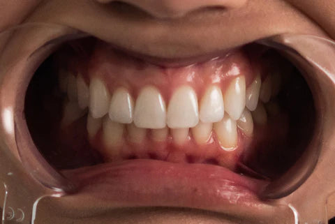 Front Bite