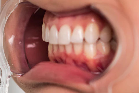Left Bite