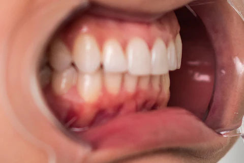 Close-up of a person's mouth with teeth showing the right side of the teeth