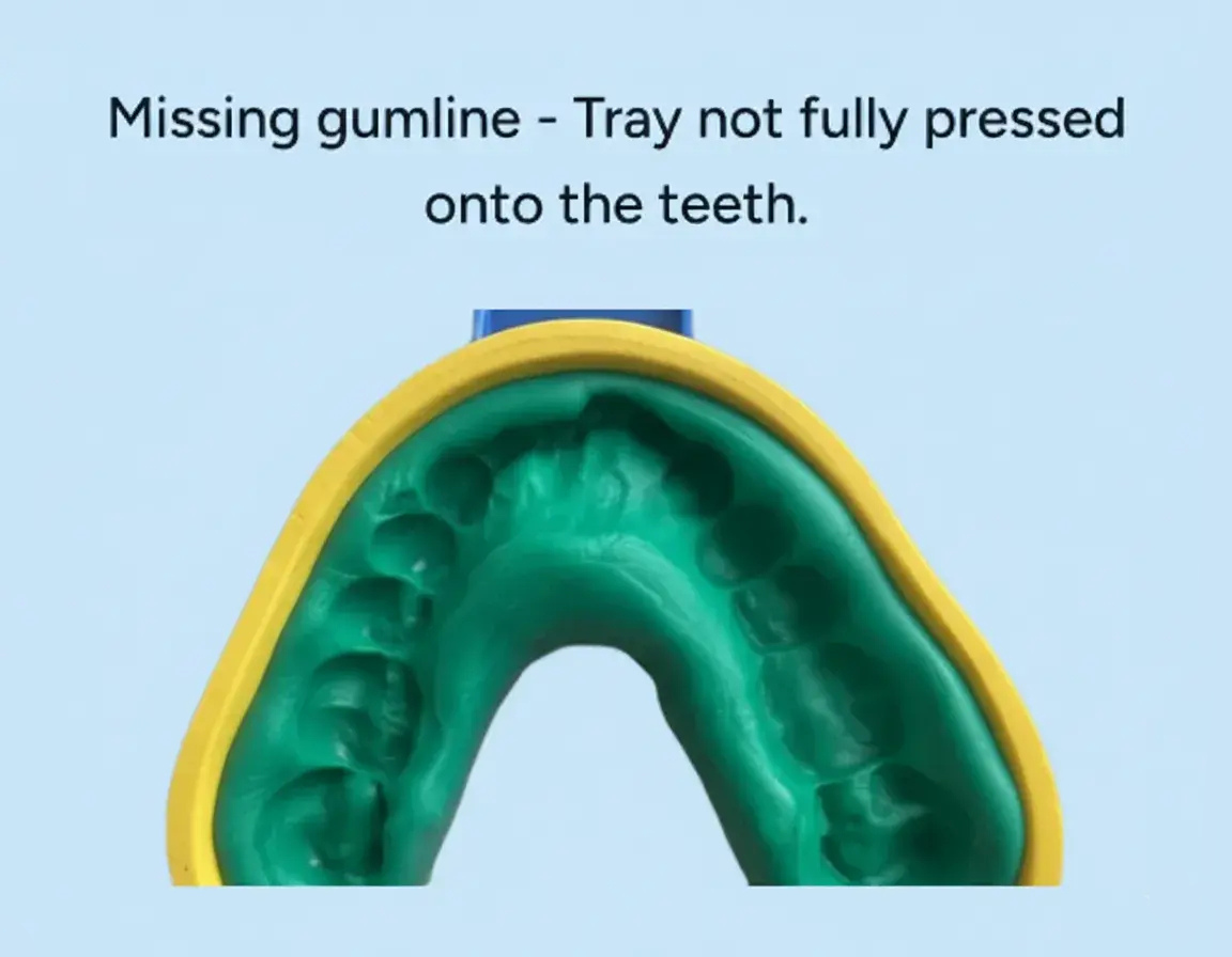 yellow dental impression tray with green putty rim on a blue background, indicating a missing gumline.