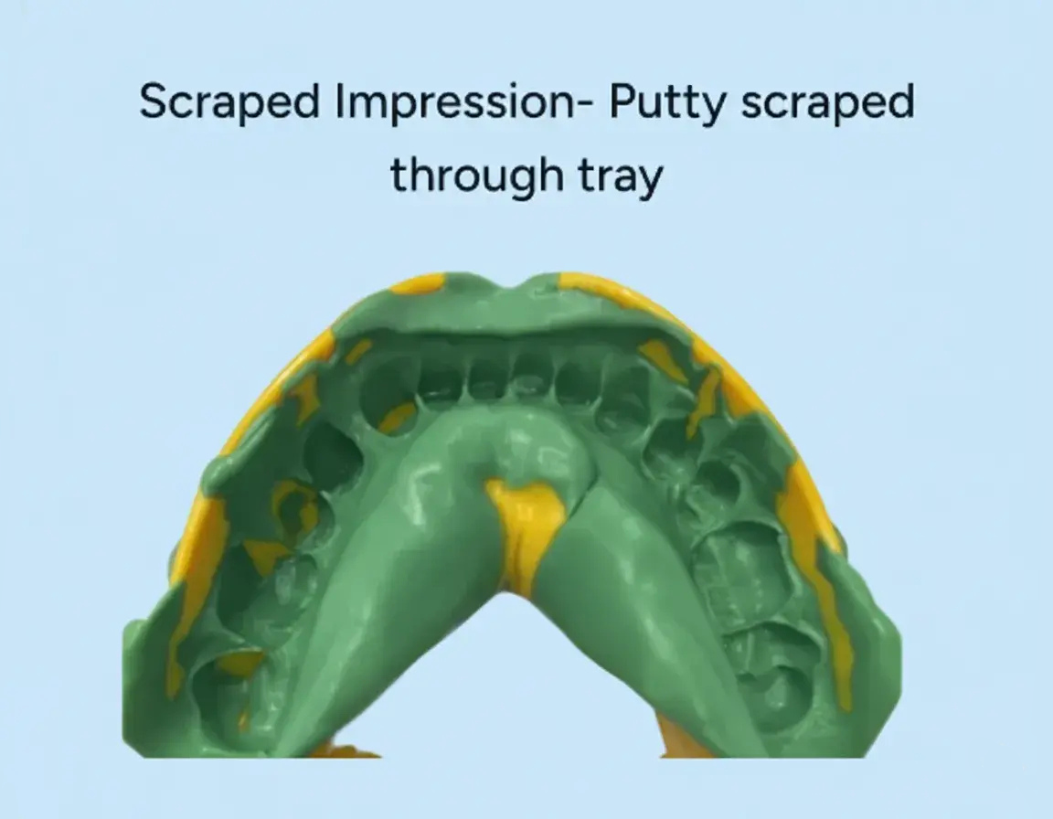 Yellow impression tray with green putty scraped through it on a blue background