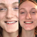 Affordable clear aligners and retainers | NewSmile 