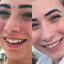 Natalie: Before and after using NewSmile aligners to fix teeth crowding