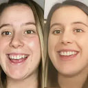 NewSmile before and after results: Transformation from crowded teeth to a straight smile