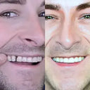 NewSmile before and after results: Transformation from spacing of teeth to a straight smile